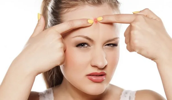 Cara Mengatasi Jerawat dengan sederhana