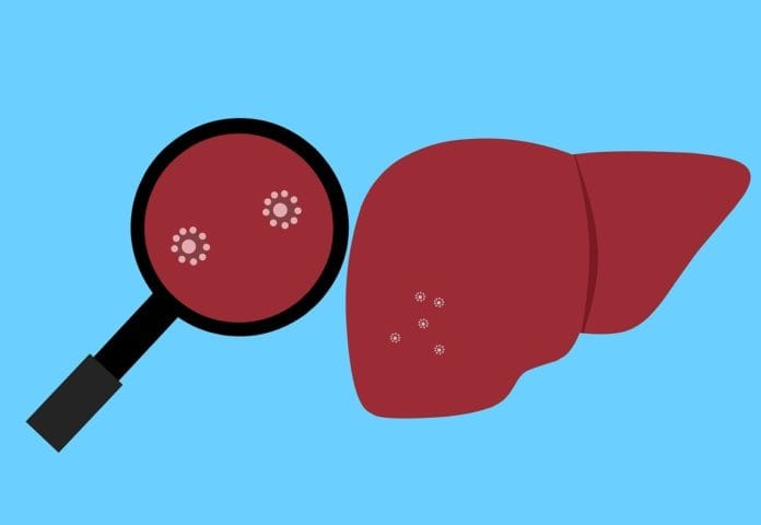 LIVER-PIXABAY Kronologi kasus Hepatitis akut yang mematikan pada anak