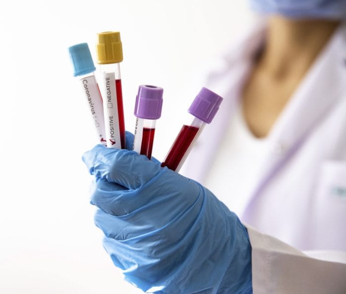 virus lagi WHO Selidiki Kemungkinan Kaitan Hepatitis Akut dengan Covid-19
