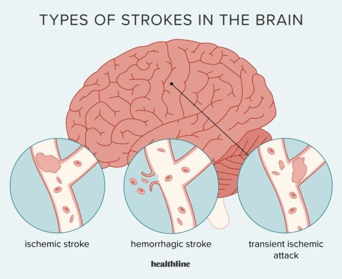Serangan Mini Stroke yang Sering Diabaikan Orang: Begini Tanda-tandanya